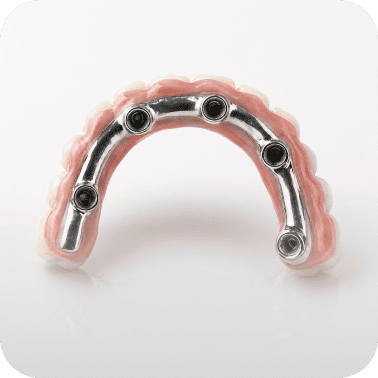 Dental implant overdenture bar with attachments for secure denture support.