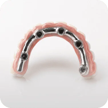 Dental implant overdenture bar with attachments for secure denture support.