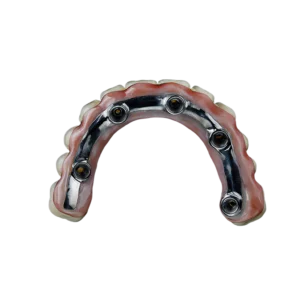 Zirconia Crown + Ti Bar (12 units)
