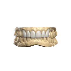 Digital Diagnostic Wax-Up
