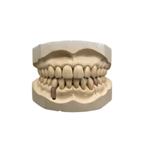 Printed Diagnostic Wax-Up