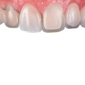Digital Smile Design
