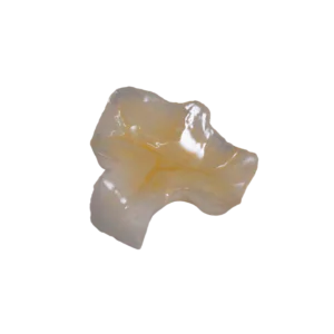 Hybrid Ceramic Onlay