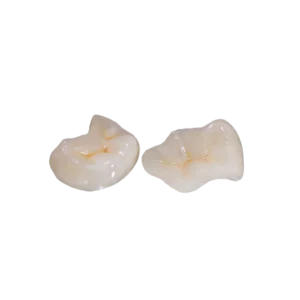 Zirconia Onlay